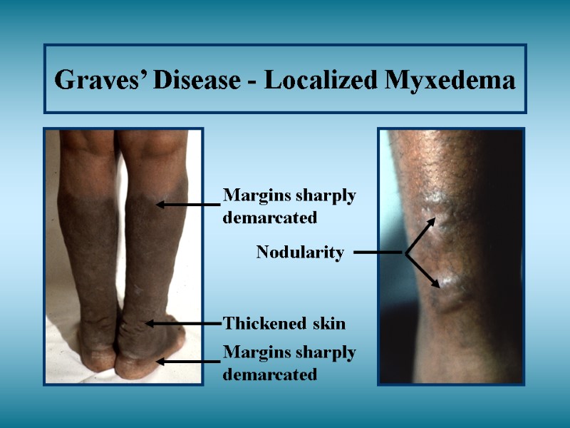 Graves’ Disease - Localized Myxedema Thickened skin Nodularity